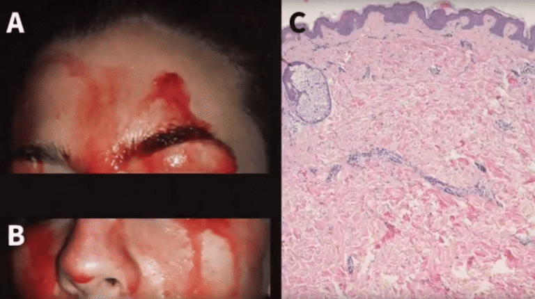 Una Joven que Suda Sangre Desconcierta a los Médicos en Italia