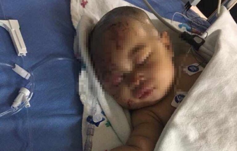 Mapache Hiere de Gravedad a Bebé de Cuatro Meses 