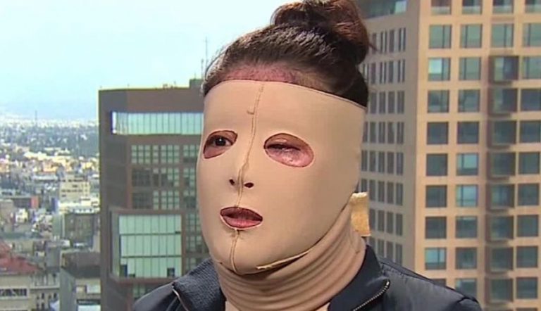 Fiscalía de Oaxaca niega protección a joven atacada con ácido