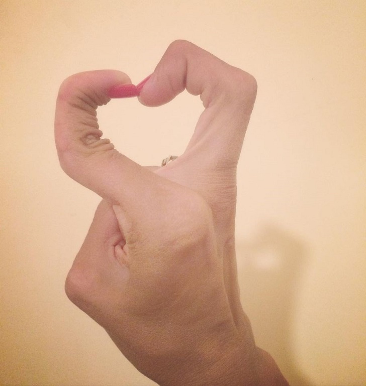 ‘El Dolor Nunca me Abandonará’ /Gioia, Ilaria y el Síndrome de Ehlers-Danlos