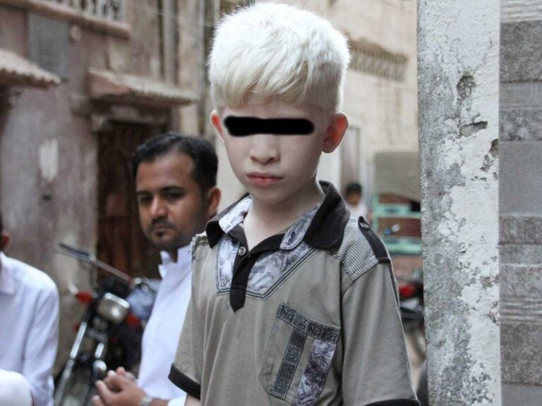 Un hombre intentó vender a sus hijos albinos para rituales de brujería