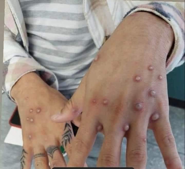 Se registran dos casos de viruela del mono en Puebla